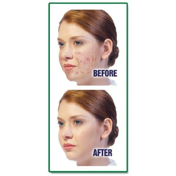 Acne Treatment Kit F-130