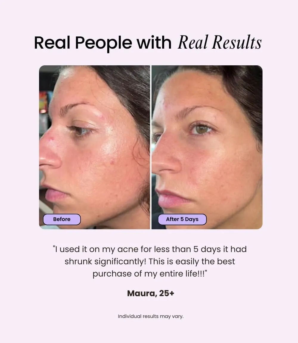 Velve Pro Skincare Wand with Blue & Red Light Therapy Simple Kit